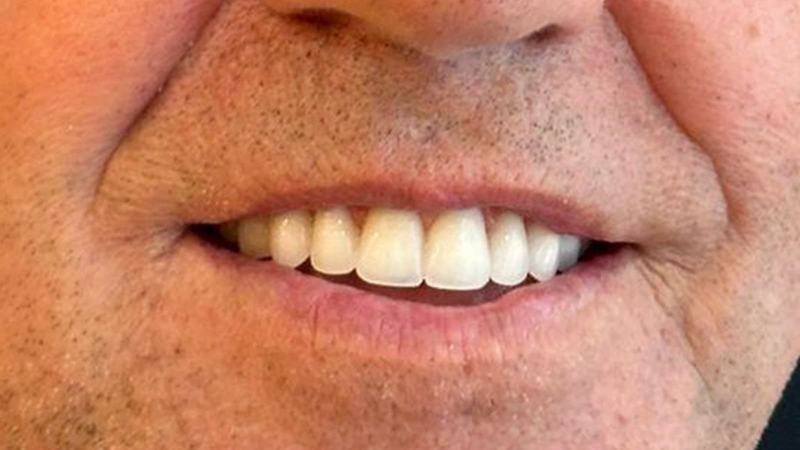 Reabilitação com implantes — depois do tratamento