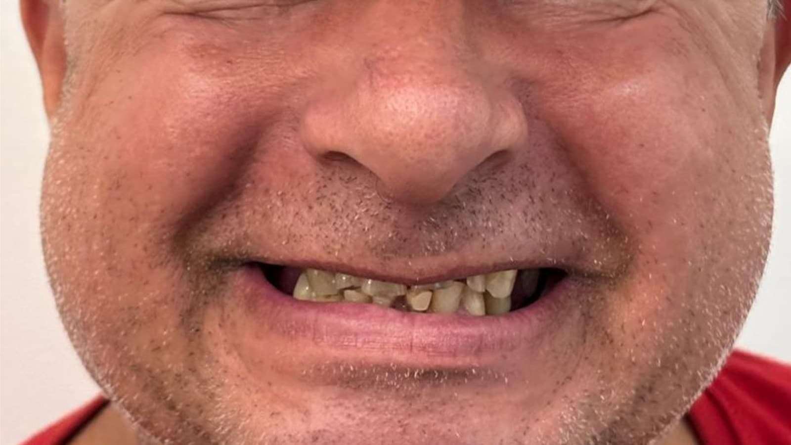 Reabilitação estética — antes do tratamento