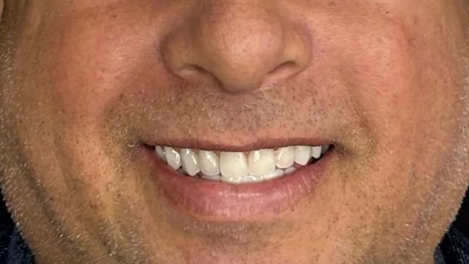 Reabilitação estética — depois do tratamento