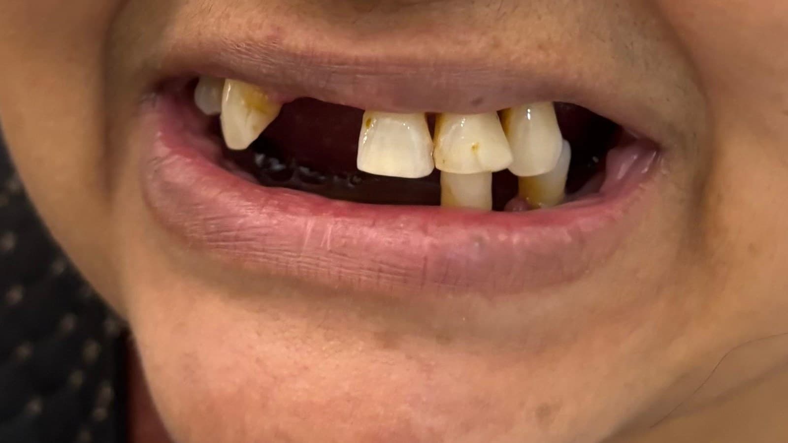 Reconstrução do sorriso — antes do tratamento