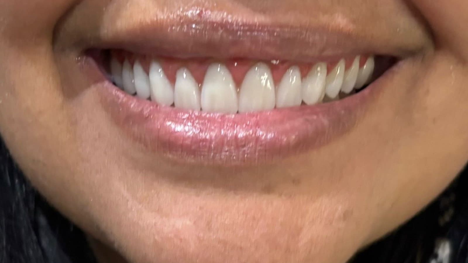 Reconstrução do sorriso — depois do tratamento
