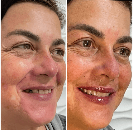 Paciente antes e depois da reabilitação estética — à esquerda, antes; à direita, depois
