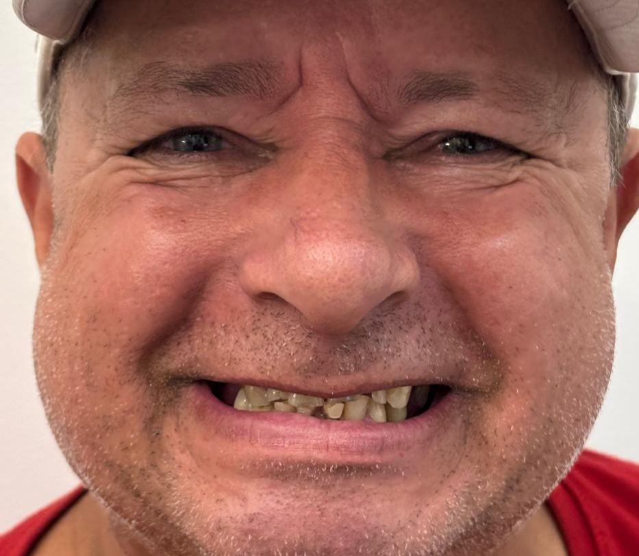 Antes - Estética Dental